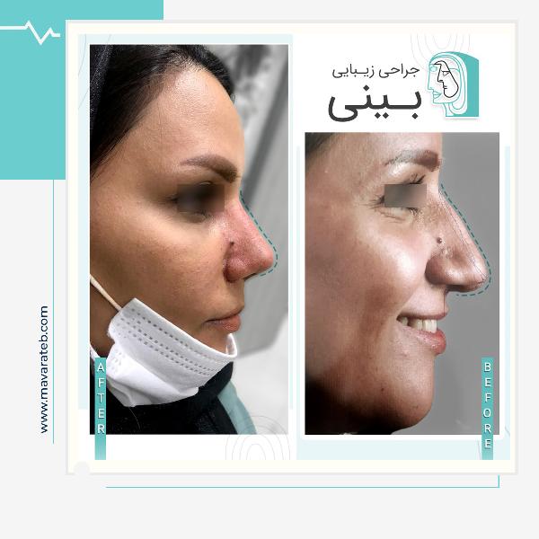 نمونه کار جراحی قوز بینی