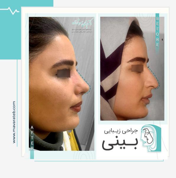 نمونه کار عمل بینی استخوانی