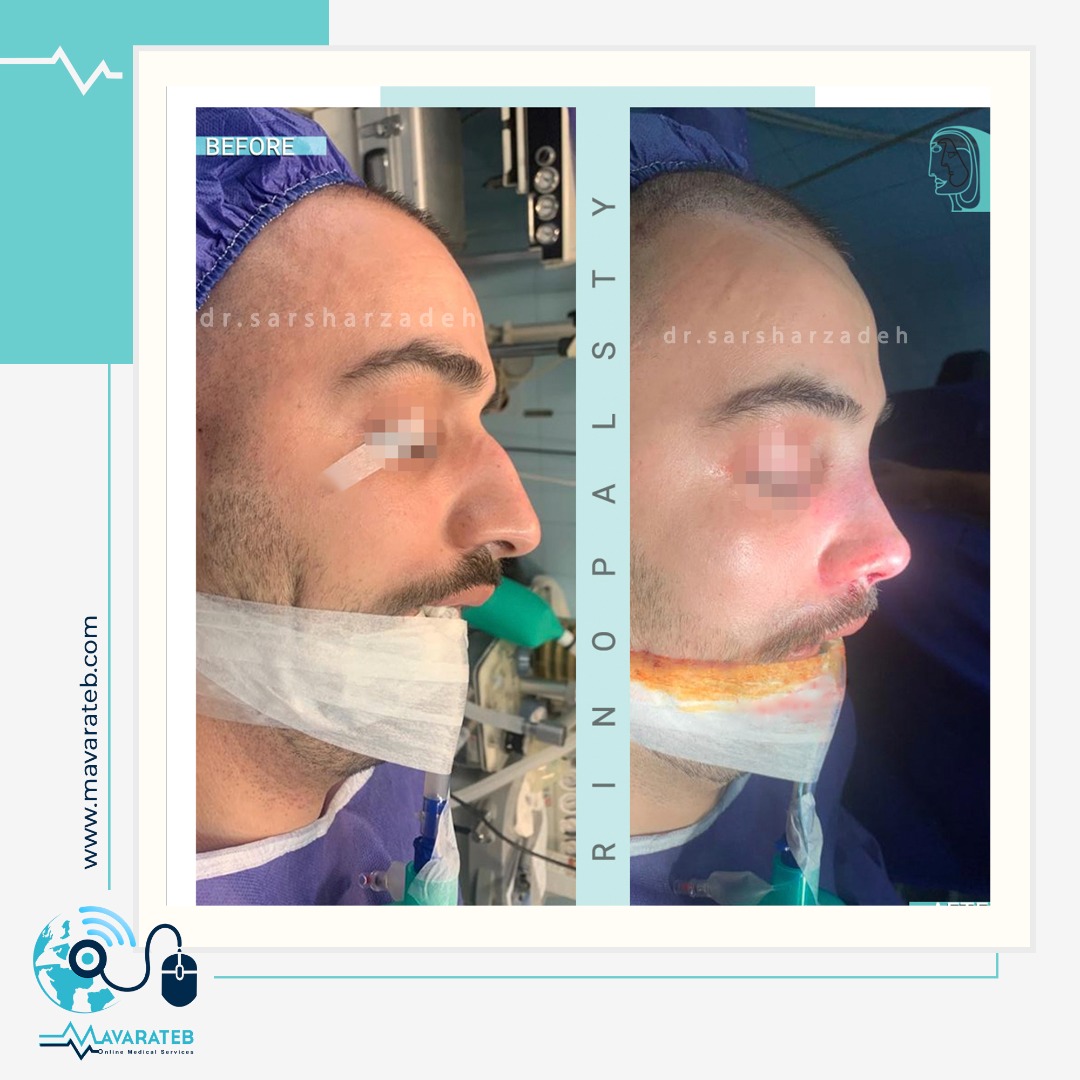 جراحی بینی مدل مردانه