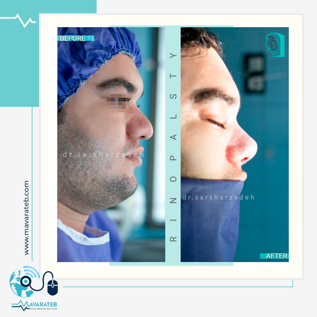 مدل رینوپلاستی مردانه