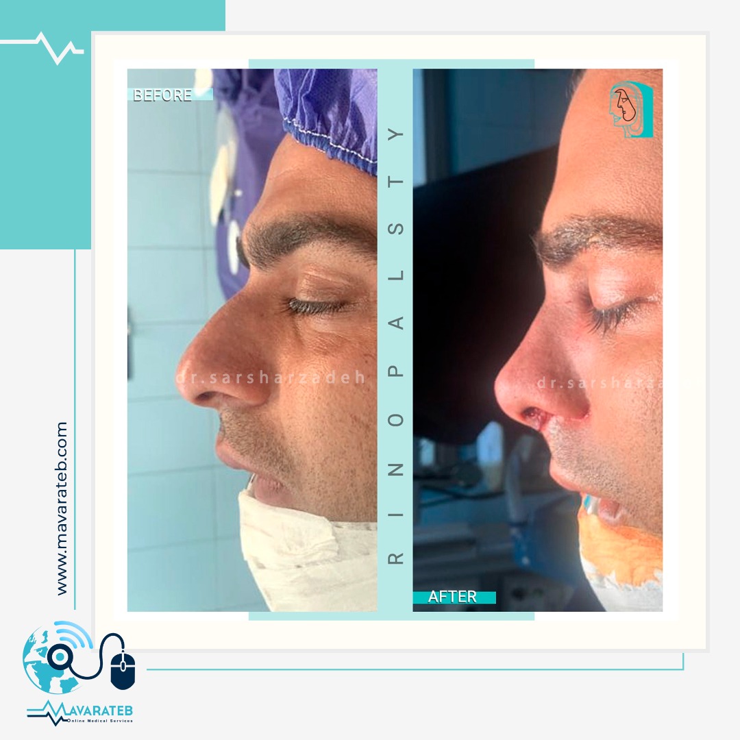 نمونه کار عمل بینی گوشتی