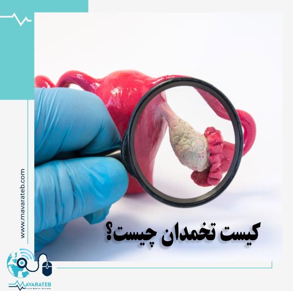 کیست تخمدان چه علائمی دارد؟