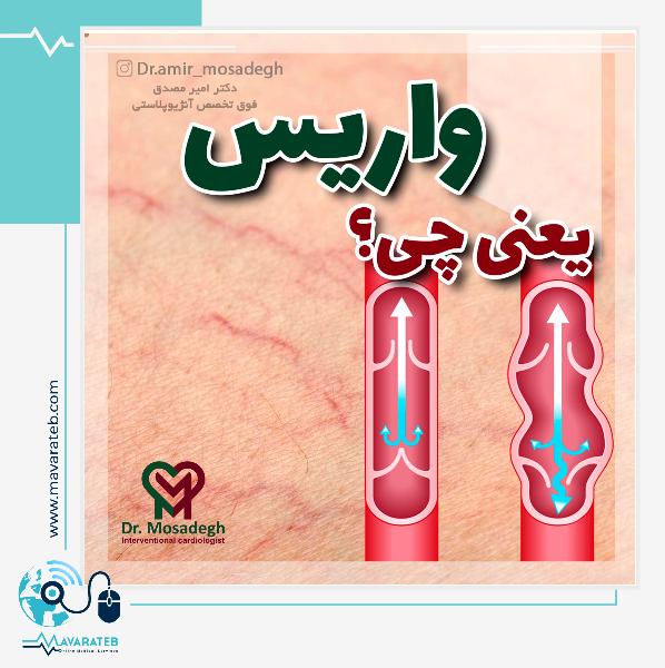 واریس یعنی چی؟!