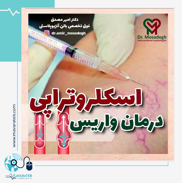 اسکلروتراپی واریس چیست؟