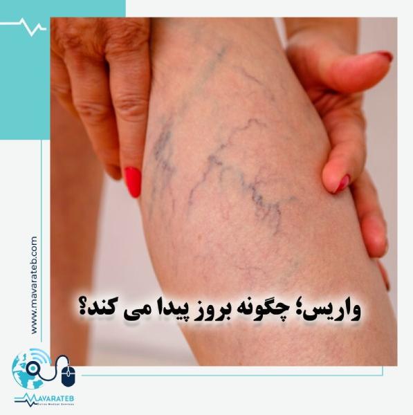 واریس چگونه بروز پیدا می کند؟