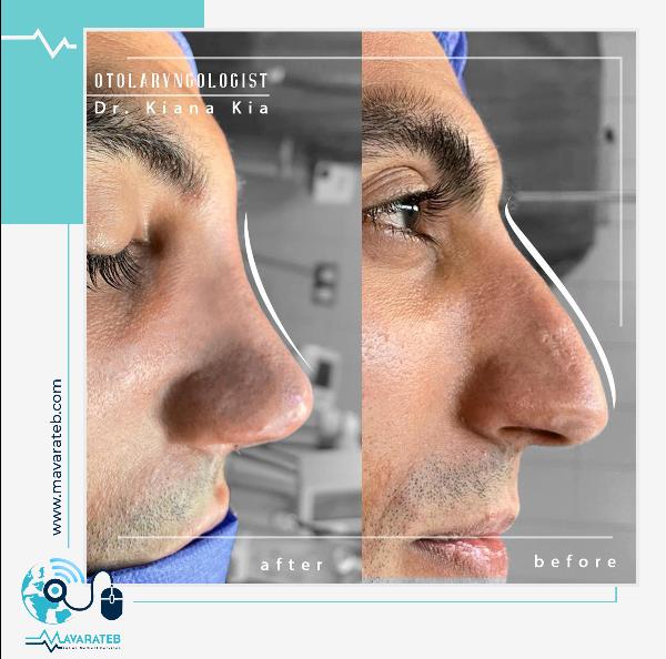 نمونه کار عمل بینی مردانه