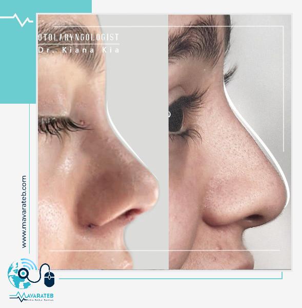 نمونه کار بینی فانتزی