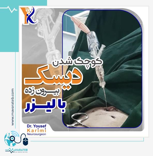 کوچک شدن دیسک بیرون زده با لیزر