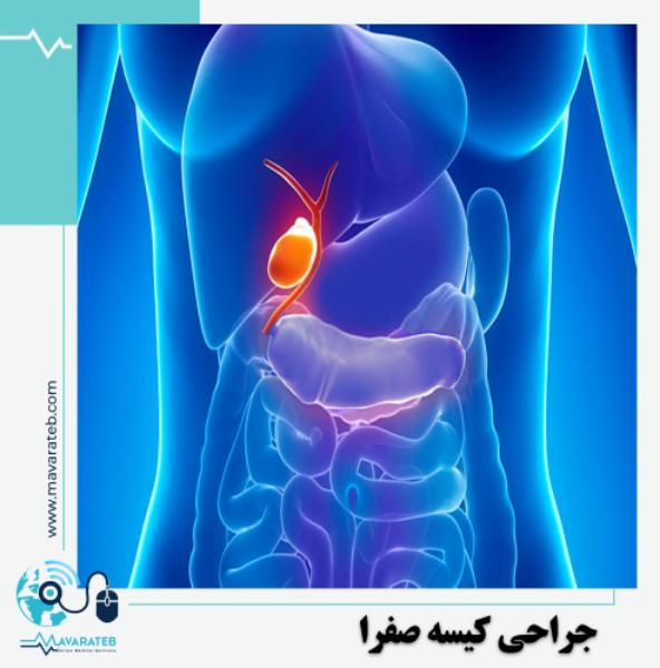 جراحی کیسه صفرا