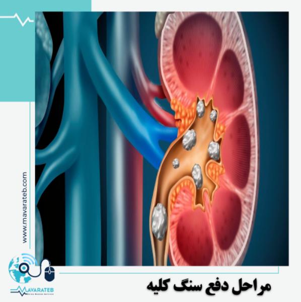 مراحل دفع سنگ کلیه