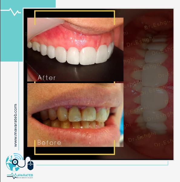 بهترین راهکار زیبایی دندان