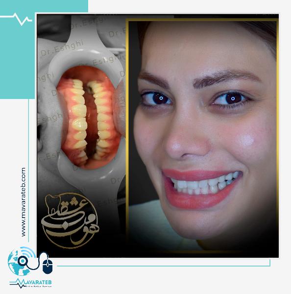 اصلاح طرح لبخند!