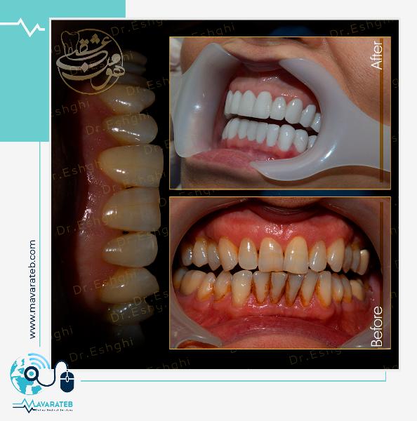 بهترین نوع کامپوزیت