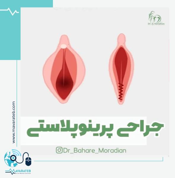 پرینوپلاستی؛ روش قطعی تنگ کردن واژن