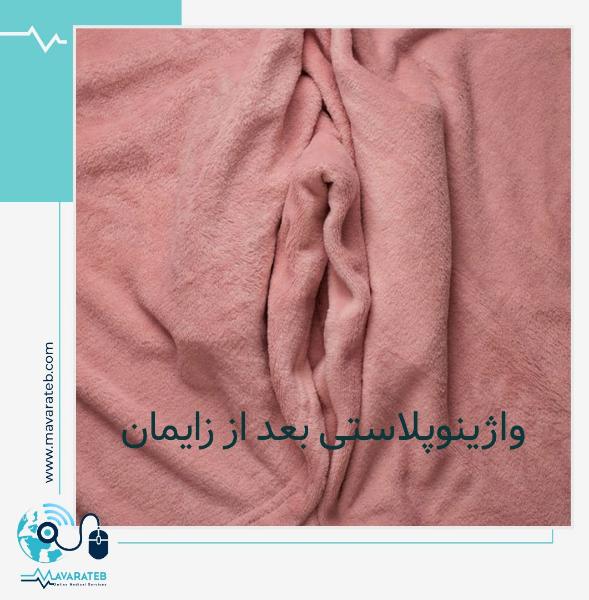 واژینوپلاستی بعد از زایمان: