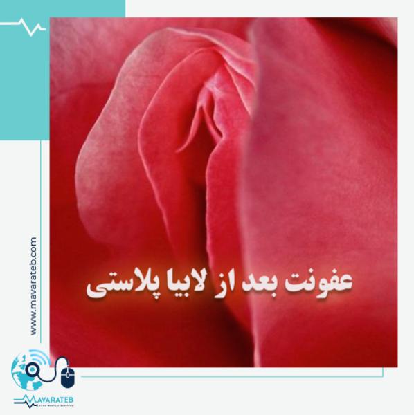 راهکارهای بهبود عفونت بعد از لابیاپلاستی