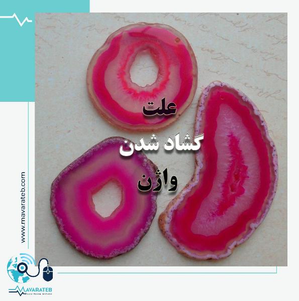 عمل تنگ کردن واژن