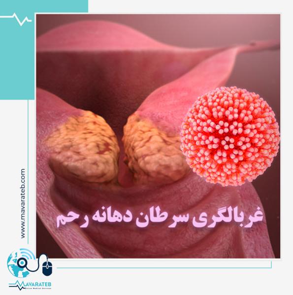 غربالگری سرطان دهانه رحم