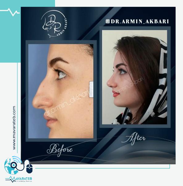 جراحی بینی استخوانی