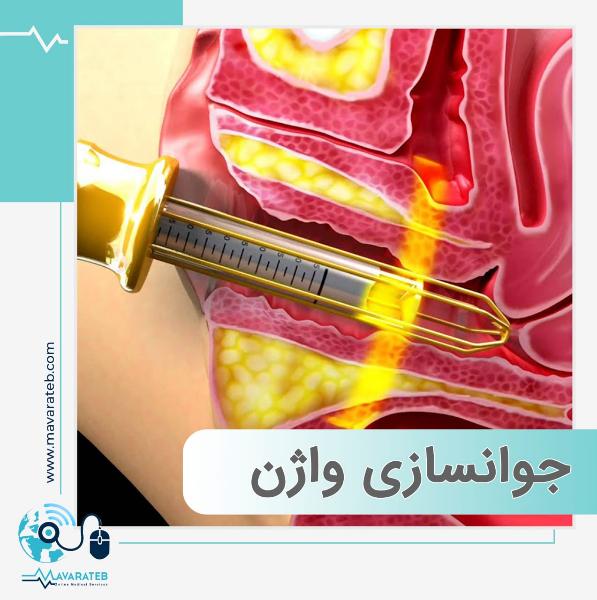 جوانسازی ناحیه تناسلی بدون نیاز به جراحی