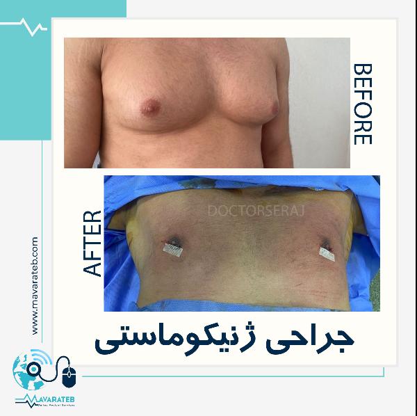 ژنیکوماستی