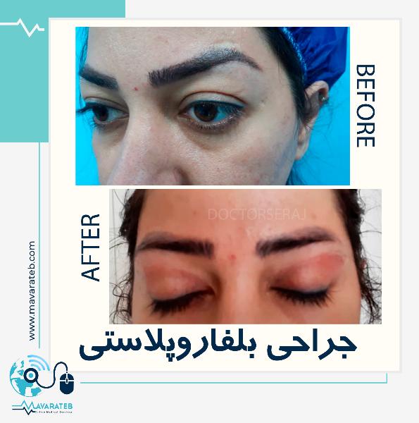 بلفاروپلاستی