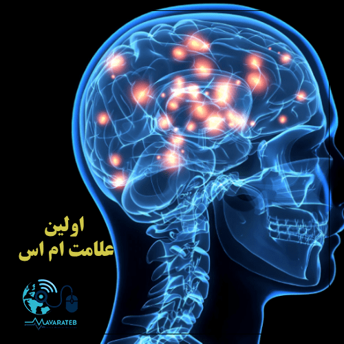 علائم ام اس در زنان