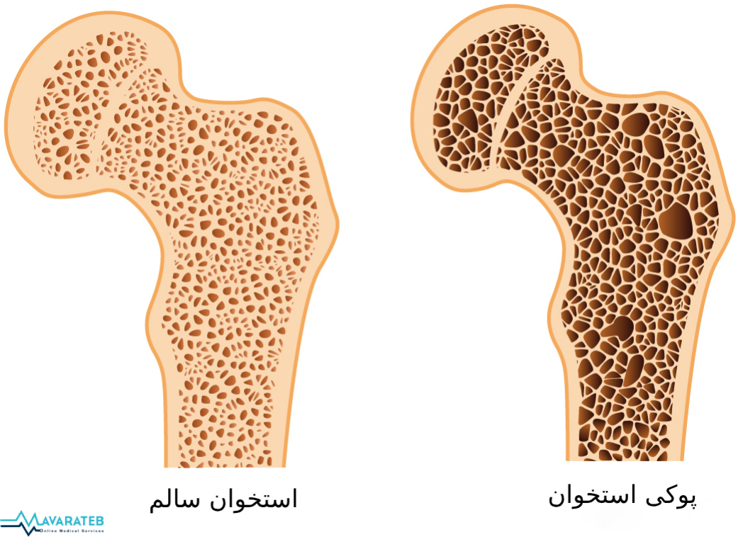 پوکی استخوان در زنان