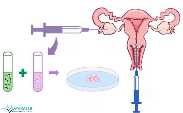 IVF برای تعیین جنسیت