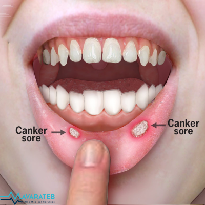 درمان سریع آفت دهان