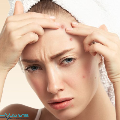 درمان خانگی جوش صورت