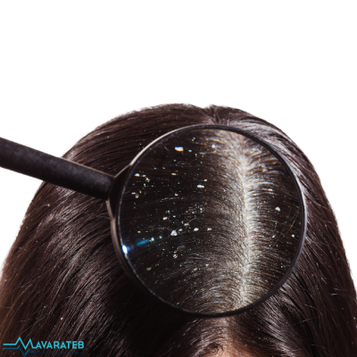 درمان خانگی شوره سر