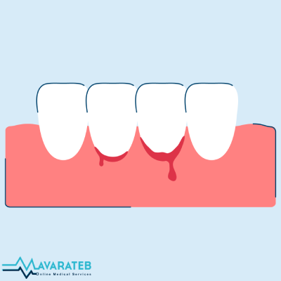 علت خونریزی لثه و روش های درمان خانگی آن