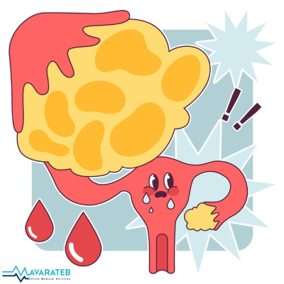 سندروم تخمدان پلی‌کیستیک (PCOS) چیست و چطور کنترل می‌شود؟